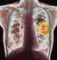 Las cajetillas de tabaco llevarán fotos de enfermos de cáncer.
