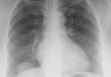 Complicaciones Orgánicas del consumo de Drogas (Parte 2ª)