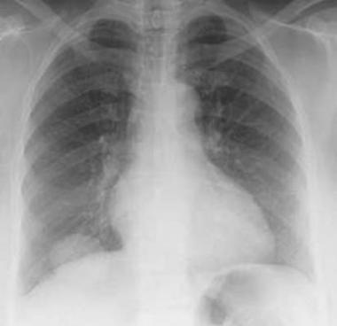 Complicaciones Orgánicas del consumo de Drogas (Parte 2ª)