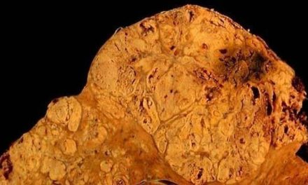 El alcohol es responsable del cáncer de hígado más letal