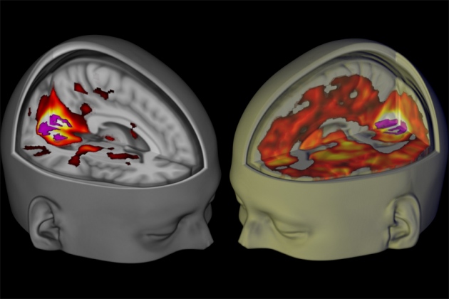 ¿Cómo se ve el cerebro de un consumidor de LSD?