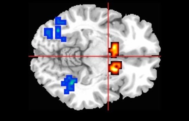 El cannabidiol ayuda a restablecer la función cerebral en la psicosis