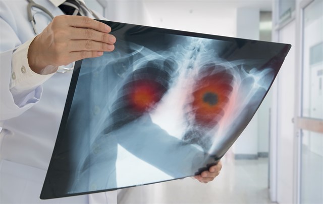 Enfisema pulmonar, el gran desconocido para muchos fumadores