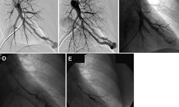 Fumar impide el tratamiento de embolización en los pulmones