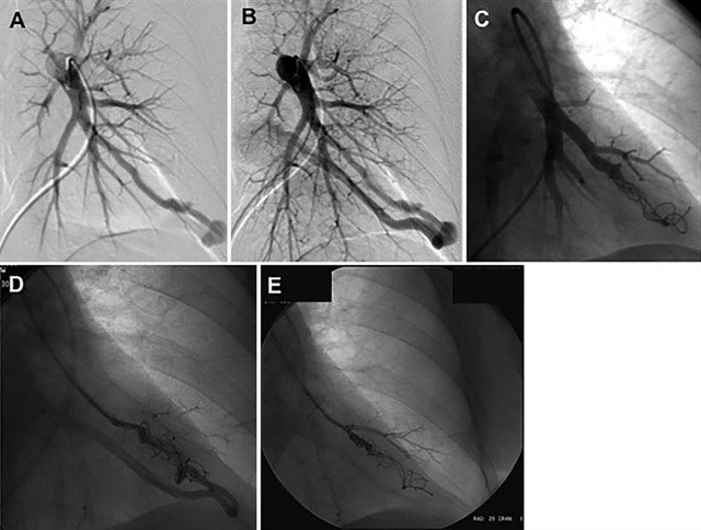 Fumar impide el tratamiento de embolización en los pulmones