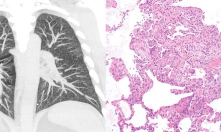 ¿Cómo se detecta la enfermedad pulmonar asociada con el vapeo?