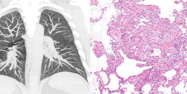 ¿Cómo se detecta la enfermedad pulmonar asociada con el vapeo?