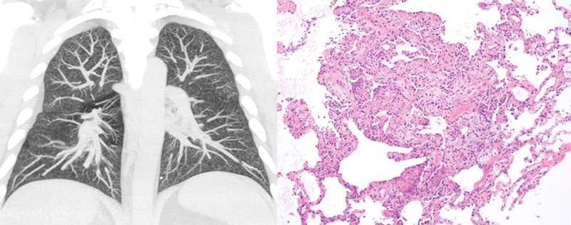¿Cómo se detecta la enfermedad pulmonar asociada con el vapeo?