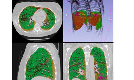 Detectan cambios en el tejido pulmonar de fumadores antes de desarrollar una enfermedad intersticial