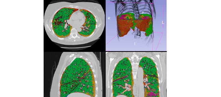 Detectan cambios en el tejido pulmonar de fumadores antes de desarrollar una enfermedad intersticial